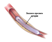 балонная ангиопластика артерии