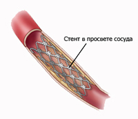 стентирование артерии