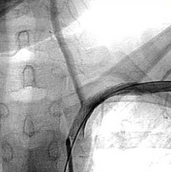 Оперативные вмешательства на подключичной артерии и плечеголовном стволе