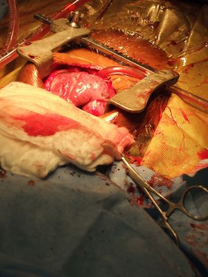 Сочетанные поражения венечных и магистральных артерий