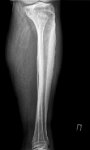 Рентгенограмма при остеомиелите большеберцовой кости