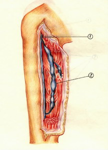 Лекция варикозная болезнь нижних конечностей thumbnail